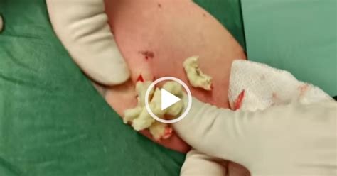 Massive Pimple Explosion Cyst Removal Clinic London Pimple Lover