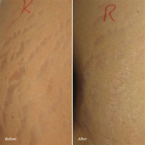 Stretchmark Before And After Photos Cosmetic Dermatology Knoxville Tn