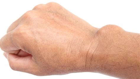 Learn About Ganglion Cyst In Patients In Singapore Abroad Pulse Play