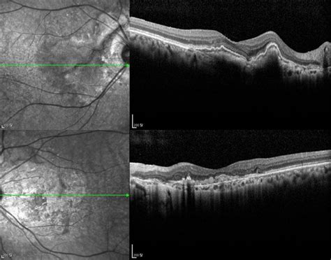 Angioid Streak Associated Choroidal Neovasclar Membranes Retina Image
