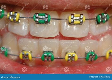 Colorful Brace Stock Photo Image Of Brace Clean Orthodontic 1634008