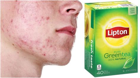 How To Use Green Tea For Acne Youtube