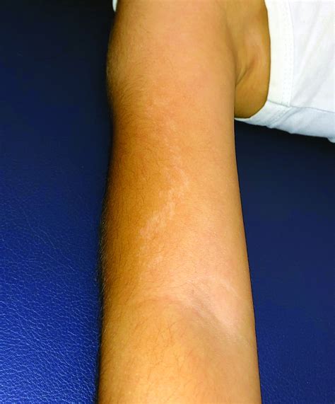 A 5 Year Old Boy With A Papular Rash On His Arm Mdedge Pediatrics