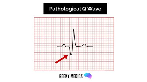 How To Read An ECG ECG Interpretation Geeky Medics