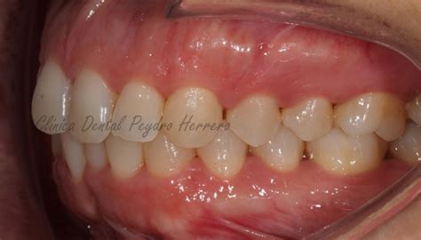 ¿cómo Arreglar La Sonrisa Gingival Con Ortodoncia Clínica Peydro
