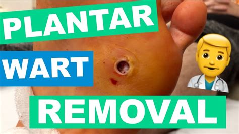 Most Professional Plantar Wart Removal Youtube