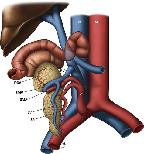 Pancreas Transplant Imaging How I Do It Radiology