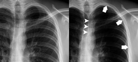 Chest X Ray Pneumothorax Gallery Normal Reference