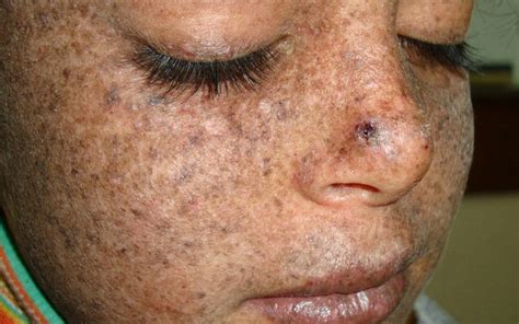 Personas Con Xeroderma Pigmentoso Presentan Sensibilidad Extrema Al Sol