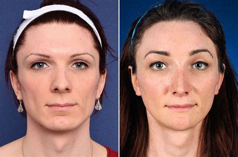 Jaw Reduction Feminizing The Jaw 2pass Clinic