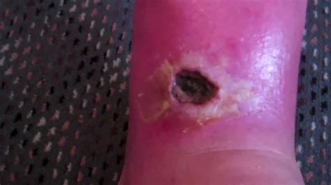 Spider Bite Wound After Five Months Brown Recluse Spider Bite Raw Youtube