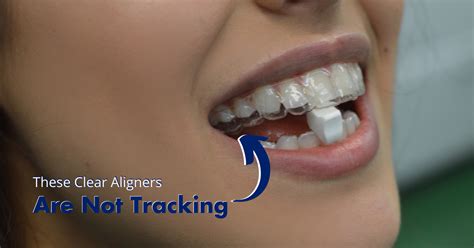 Why Invisalign Tracking Is Crucial For Tooth Movement Movemints