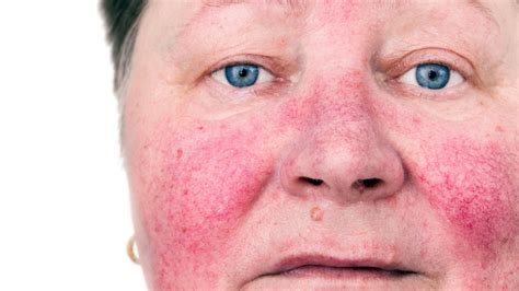 Treating Rosacea On The Face Spot Check Skin Cancer Aesthetics Melbourne Cbd