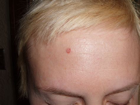 Small Bumps Forehead Hairline Growth