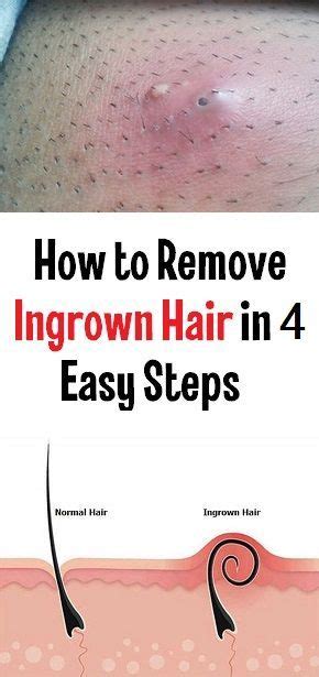 How To Remove Ingrown Hair In 4 Easy Steps Ingrown Hair Removal Ingrown Hair Ingrown Leg Hair