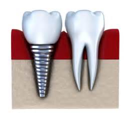 Fort Worth Tx Nobel Biocare Dental Implants Benefits And Advantages