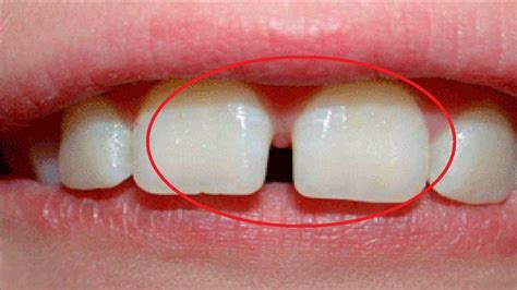 Can you straighten your teeth with. how to get rid of gaps in your teeth naturally at home ...