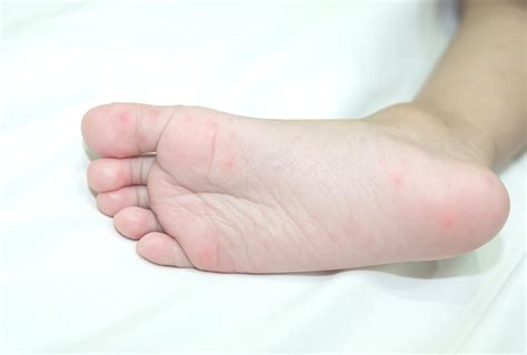 Red Spots On Feet Causes How To Treat Them Emedihealth