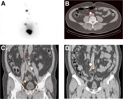 Value Of Spectct For Detection And Anatomic Localization Of Sentinel