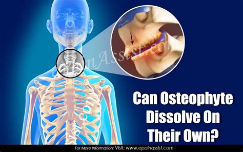 Can Osteophytes Dissolve On Their Own