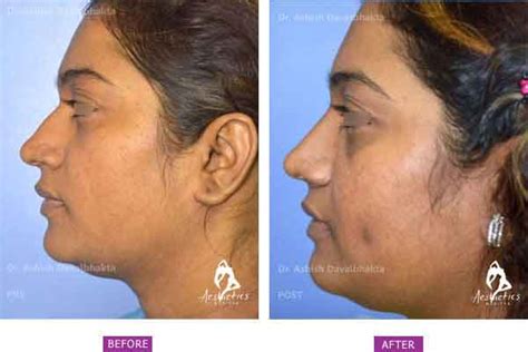 Dimple = digital made simple. Dimple Surgery at Pune's Number 1 Clinic. Now you can get ...
