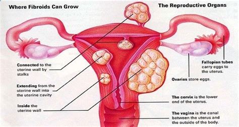 Because a woman keeps her uterus, she may still be able to have children. Amazing Herb Drink For Fibroids And Ovarian Cysts ...