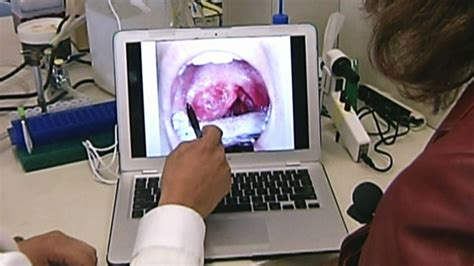 Dramatic Increase In Hpv Related Mouth Throat Cancers Among Canadian