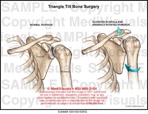 Triangle Tilt Bone Surgery Medical Illustration Medivisuals