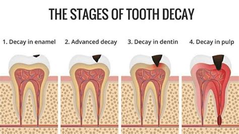 tooth cavity  dental emergency