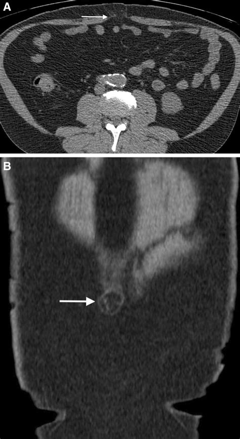 Primary Abdominal Wall Hernias A Axial Ct Contrast Enhanced Image And