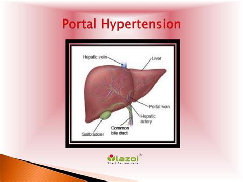 Ppt Portal Hypertension Causes Symptoms Daignosis Prevention And