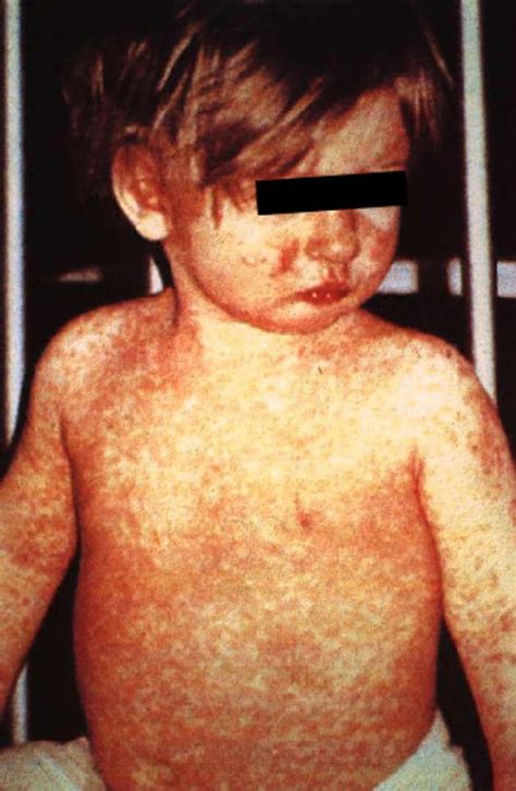 Measles Physical Examination Wikidoc