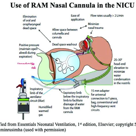 Nasal Interfaces To Provide Niv Download Scientific Diagram