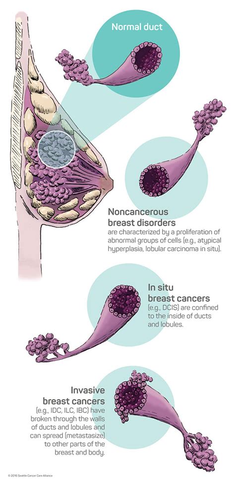 Conditions And Types Of Breast Cancer Seattle Cancer Care Alliance