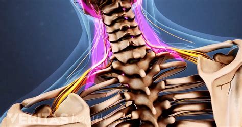 How To Relieve Nerve Pain In Shoulder And Neck Postureinfohub
