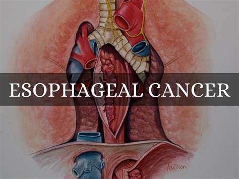 Esophagus Cancer