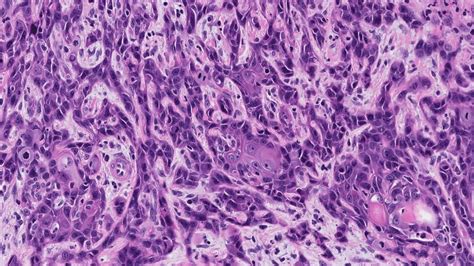 Squamous Cell Carcinoma Of The Oral Cavity Atlas Of Pathology