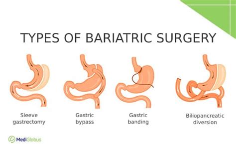 Best Weight Loss Surgery In Fazilka Top Bariatric Surgeon Fazilka