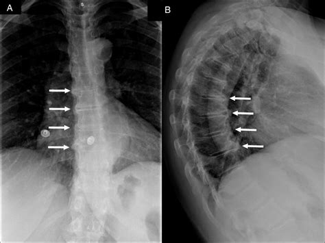 Anteroposterior A And Lateral B Radiographs Of Thoracic Spine