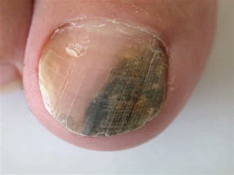 Nail fungus is one of the most common 'nail diseases.' many people associate it only with toenails. Black Spot On Nail in 2020 | Acrylic nails, Green acrylic ...