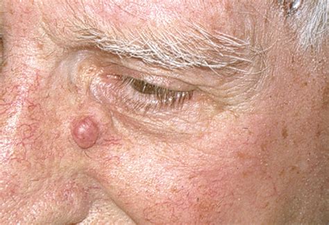 Adjacent Dermal Nodules On The Nose—case Dermatology Jama