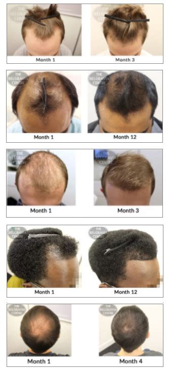 The anagen or growth stage lasts between two to six years. Hair Loss Treatment Effective