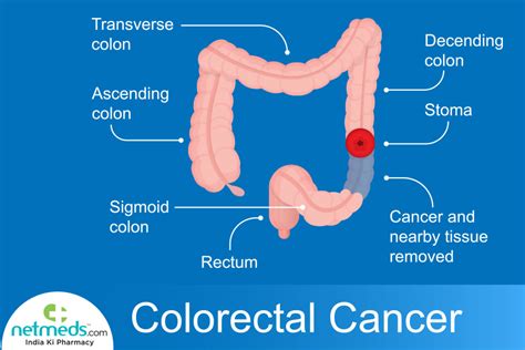 9 Best Ideas For Coloring Sign Of Colon Cancer