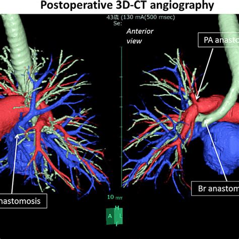 Postoperative Three Dimensional 3d Computed Tomography Ct No