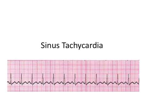 Sinus Takikardi Ekg Hot Sex Picture