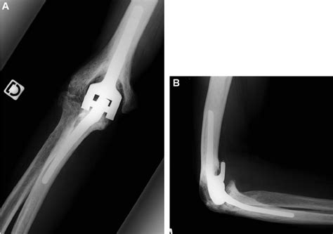 A And B X Rays Of The Coonradmorrey Total Elbow Used In A Rheumatoid