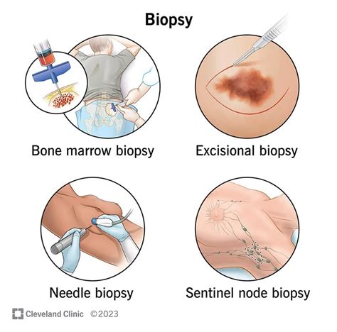 What Is A Biopsy Purpose And Results