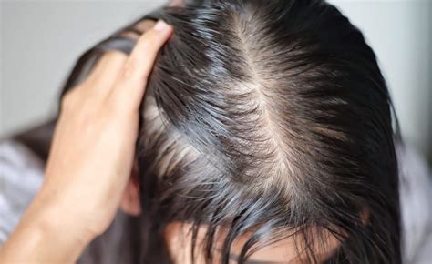 Scalp Conditions How To Recognize Them