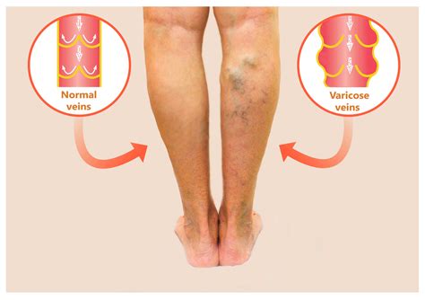 Varicose Veins Know Your Treatment Options Vein Clinic