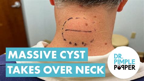 Massive Lipoma Takes Over Neck Dr Pimple Popper Saves The Day Cystactular Cysts Dr Pimple